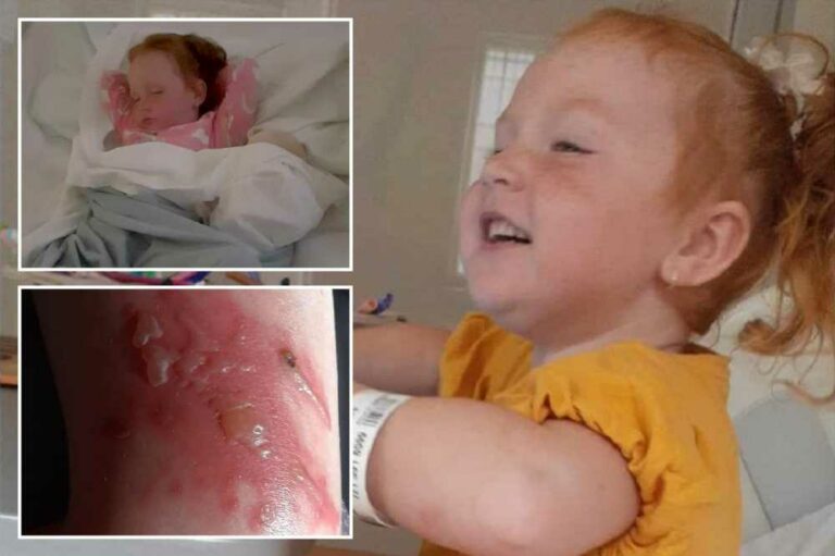 My daughter, 4, is scarred for life after brushing past Britain's most dangerous plant – her blisters turned BLACK | The Sun